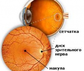 Дегенерация сетчатки глаза